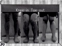 knee in toe out 2
